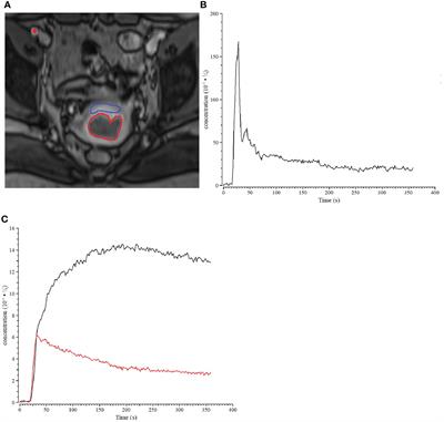 Evaluation of tracer kinetic parameters in cervical cancer using dynamic contrast-enhanced MRI as biomarkers in terms of biological relevance, diagnostic performance and inter-center variability